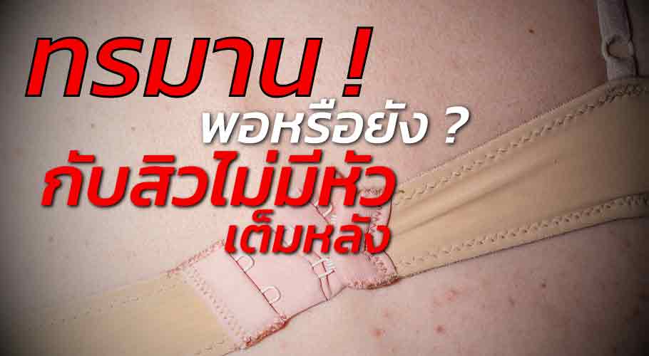สิว ไม่มี หัว